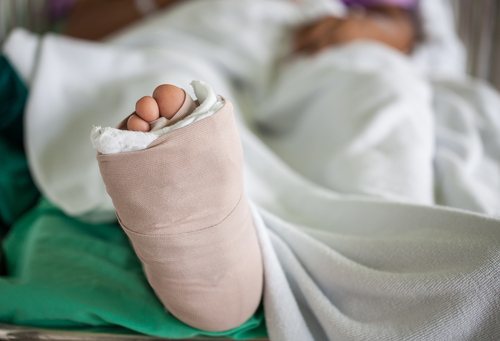 primer plano de un pie cubierto con yeso, persona acostada en una cama de hospital