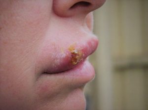 Can I sue someone for giving me herpes?