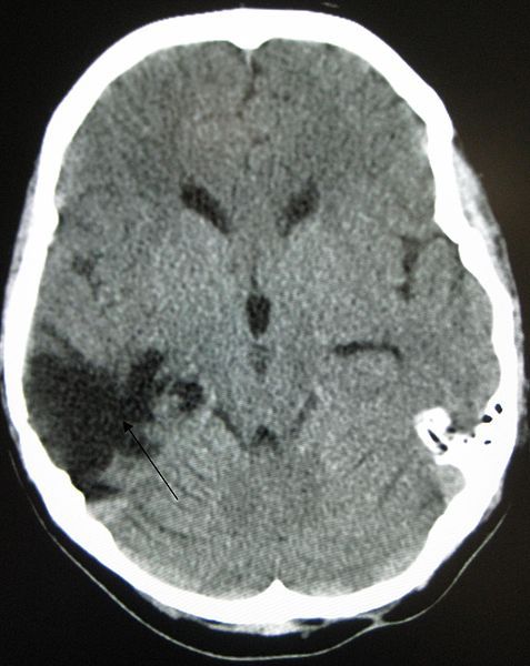 Cross section of brain showing traumatic brain injury
