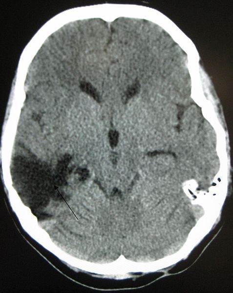 Sección transversal del cerebro mostrando lesión cerebral traumática