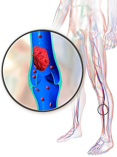 illustration of deep vein thrombosis