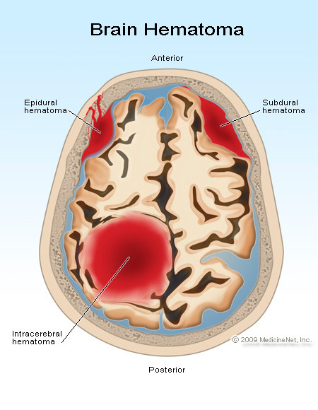 Cross-section of brain showing hematoma