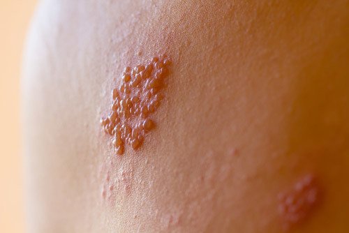 shingles on patient
