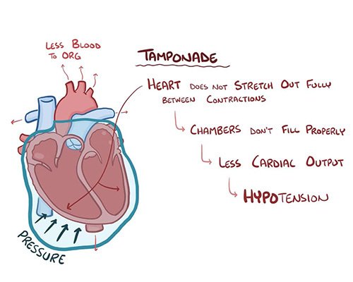 illustration depicting cardiac tamponade