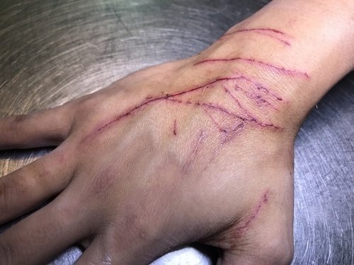 human hand covered in cat scratches