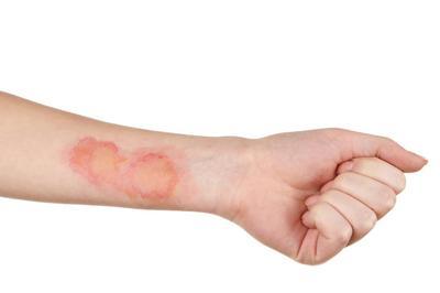 una persona con marcas de quemaduras en el brazo