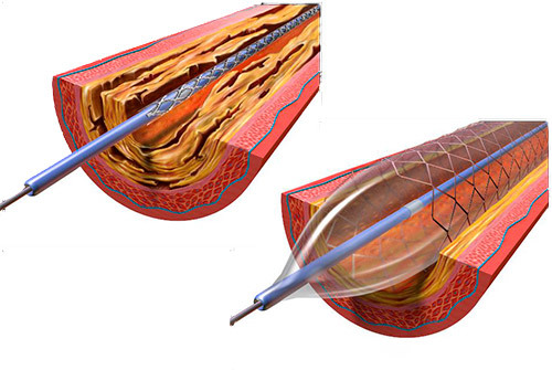 illustration of a stent