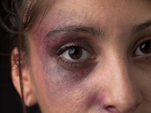 young women with bruises around her eye