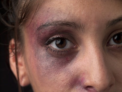mujer joven con moretones alrededor del ojo