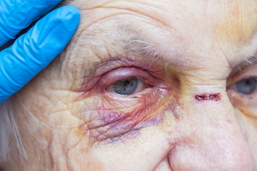 Mujer anciana con moretones en la cara y una mano con un guante de látex examinándola suavemente