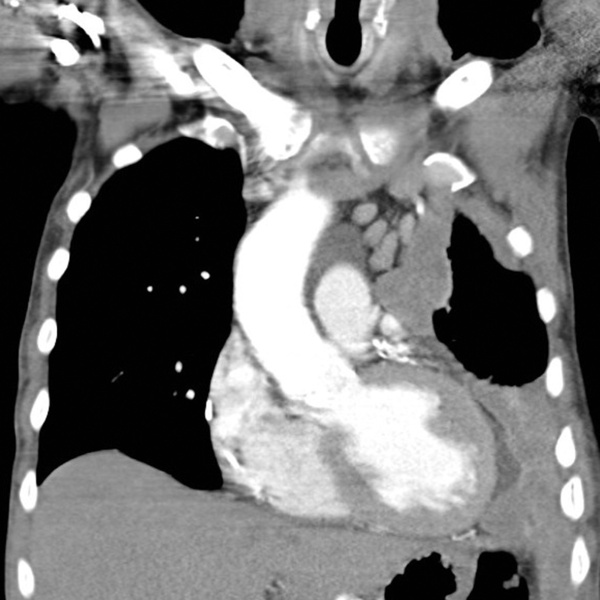 Radiografía mostrando mesotelioma en los pulmones