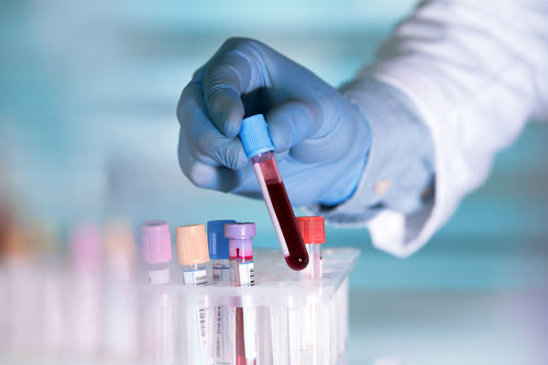 técnico de laboratorio sosteniendo un frasco de sangre - las pruebas de sangre son comunes en casos de DUI de marihuana