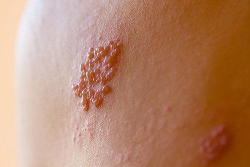 zostavax shingles