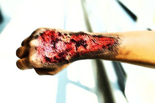 arm and hand with severe burn injuries