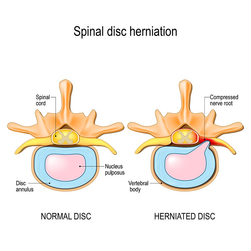 graphic visualizing a herniated disc