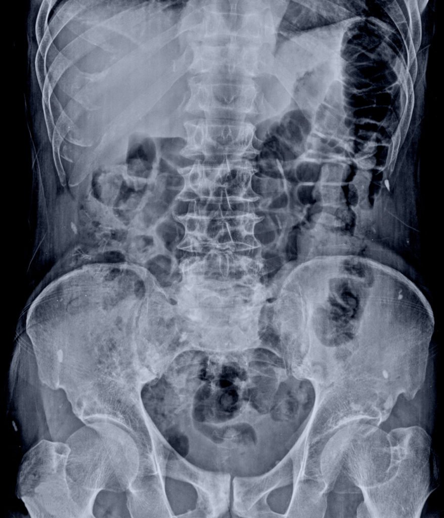 X-ray showing perforated gastrointestinal organs. 