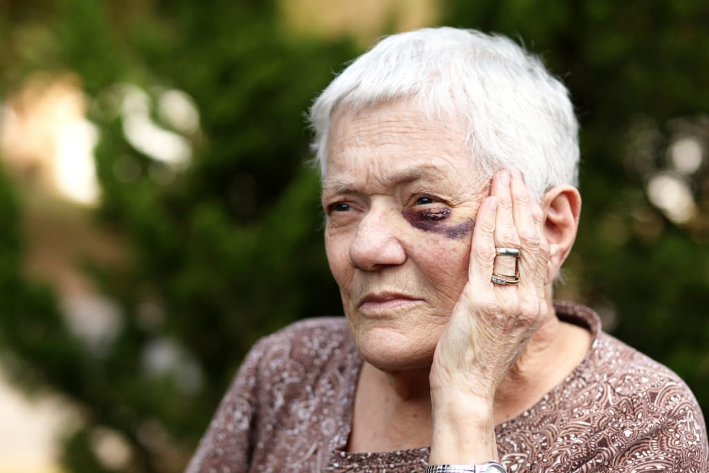 Elderly person with a black eye from being abused