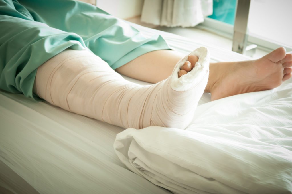 Leg in cast on a hospital bed, considered a serious bodily injury in Colorado