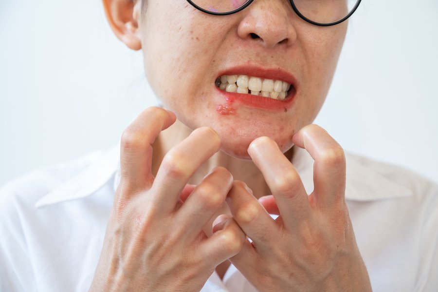 Mujer con herpes en el labio inferior, y está haciendo una mueca y se está agarrando los dedos con frustración