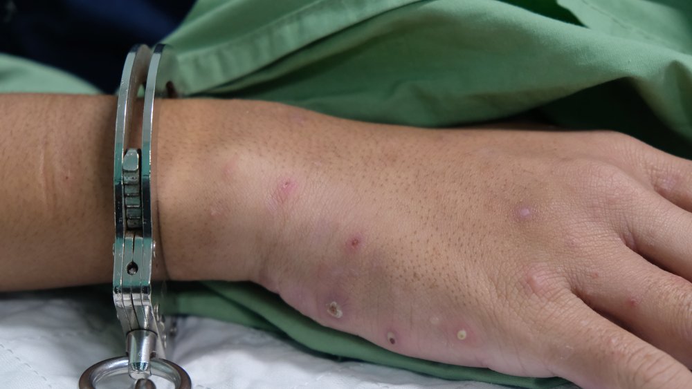 A patient wearing handcuffs.