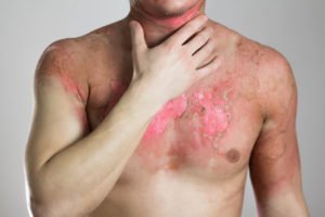 A man with sever burn injuries on his upper chest.