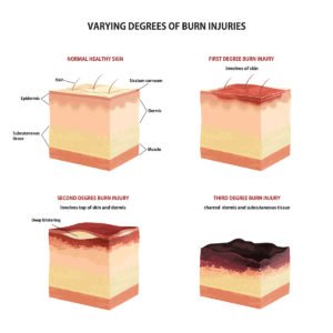 Diagram of different degrees of burns