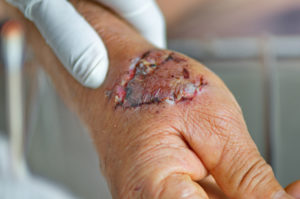 A gruesome dog bite scar on a person's hand.