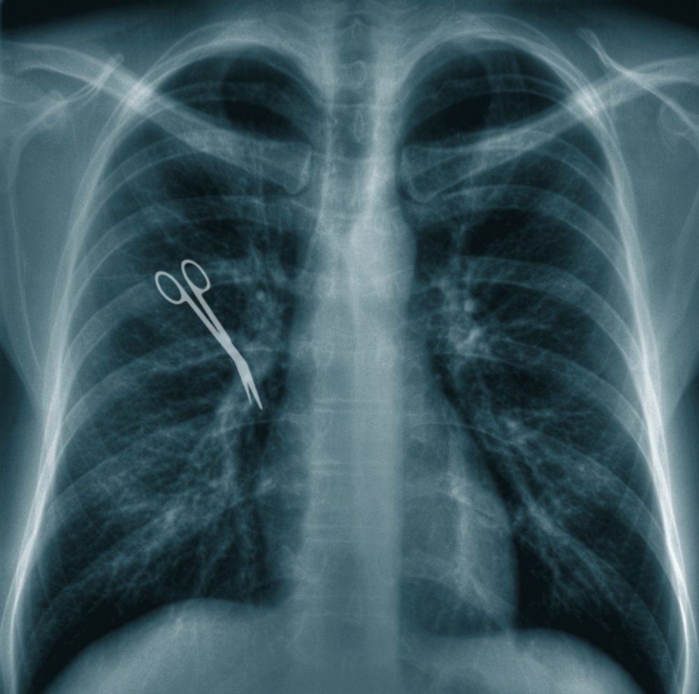 An Xray of a surgeon's scissors in a patient's chest area.