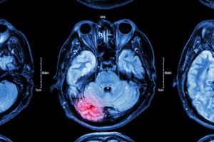 MRI of damaged brain following an accident