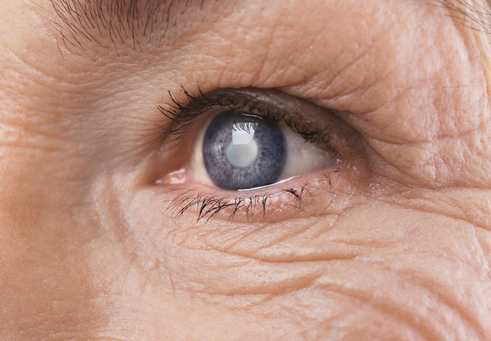 A woman with a cataract in her eye.