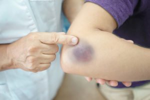 doctor pointing to bruise on patient's elbow