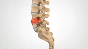 A graphic illustration depicting degenerative disc disease on a spine.
