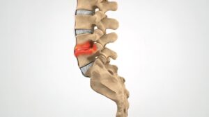 An illustration of a spinal cord with degenerative disc disease.