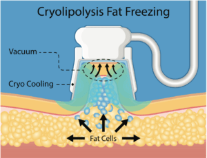 Cartoon rendering of cryolipollysis fat freezing