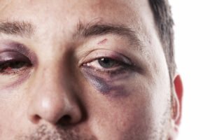 Close-up of man with black eye