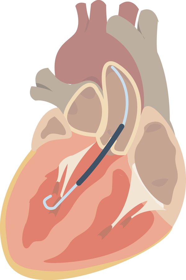 Diagram of Impella support in heart failure
