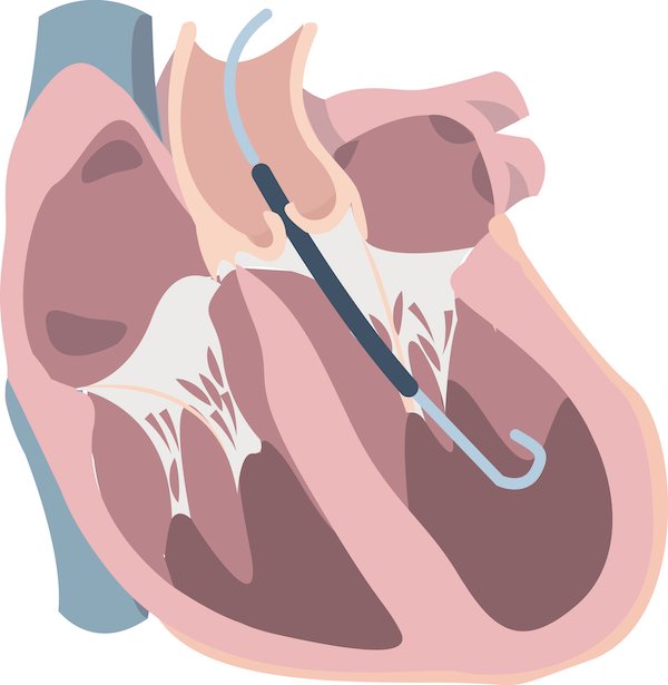 Heart failure with Impella support of left ventricle