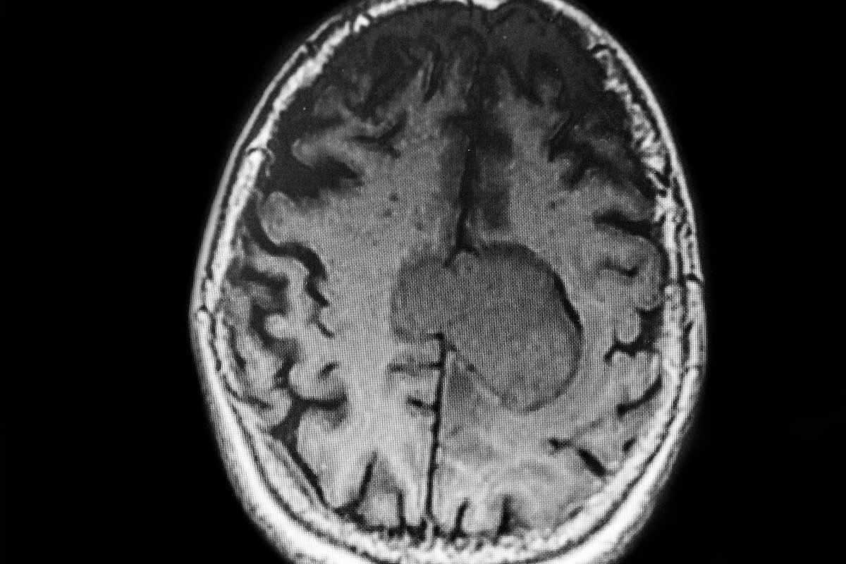 Brain scan showing meningioma against a black background